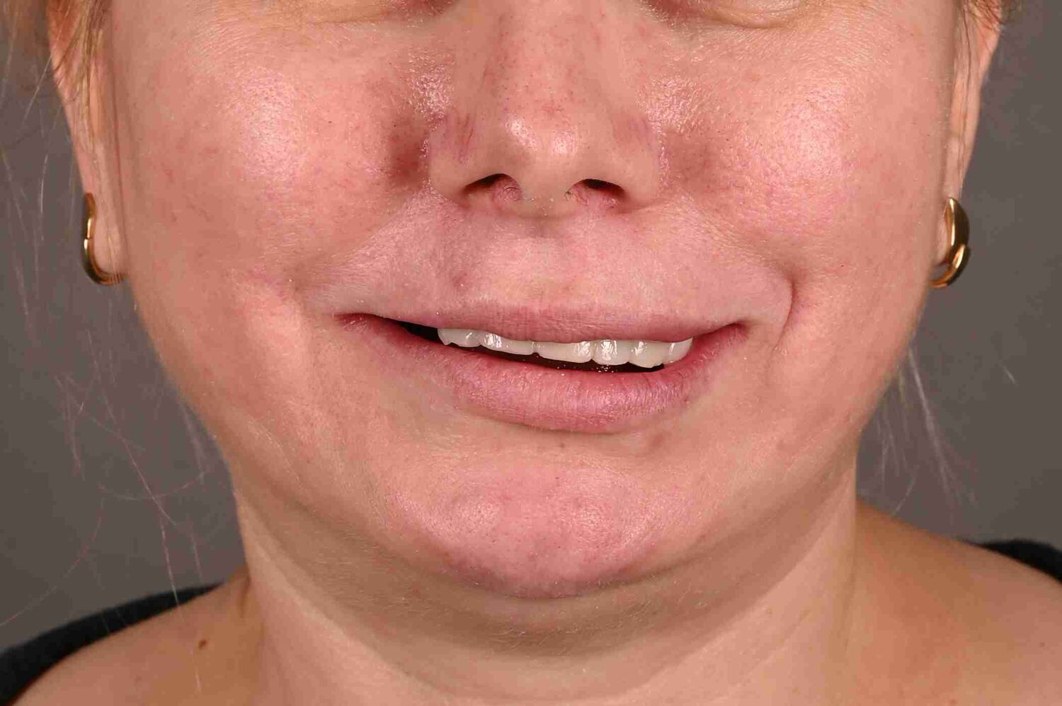 Pacient Clinica Dr. Alin Odor - Rezultat Implantologie